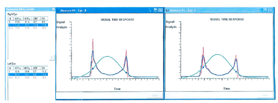 Ocular Response Analyzer