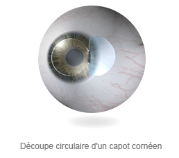 Découpe circulaire d'un capot cornéen Découpe circulaire d'un capot cornéen