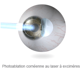 Photoablation cornéenne au laser à excimères Photoablation cornéenne au laser à excimères