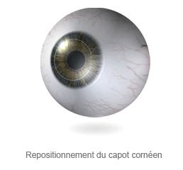 Repositionnement du capot cornéen Repositionnement du capot cornéen