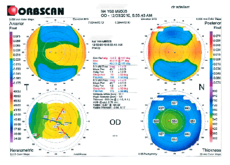 Topographie Orbscan